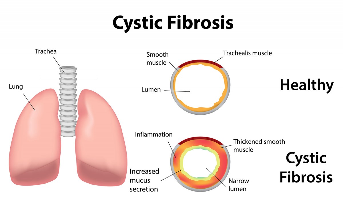 What Are The Signs And Symptoms Of Cystic Fibrosis Cystic Fibrosis Dna