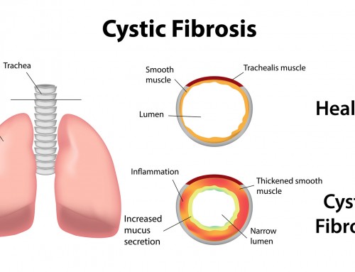 What are the signs and symptoms of Cystic Fibrosis?