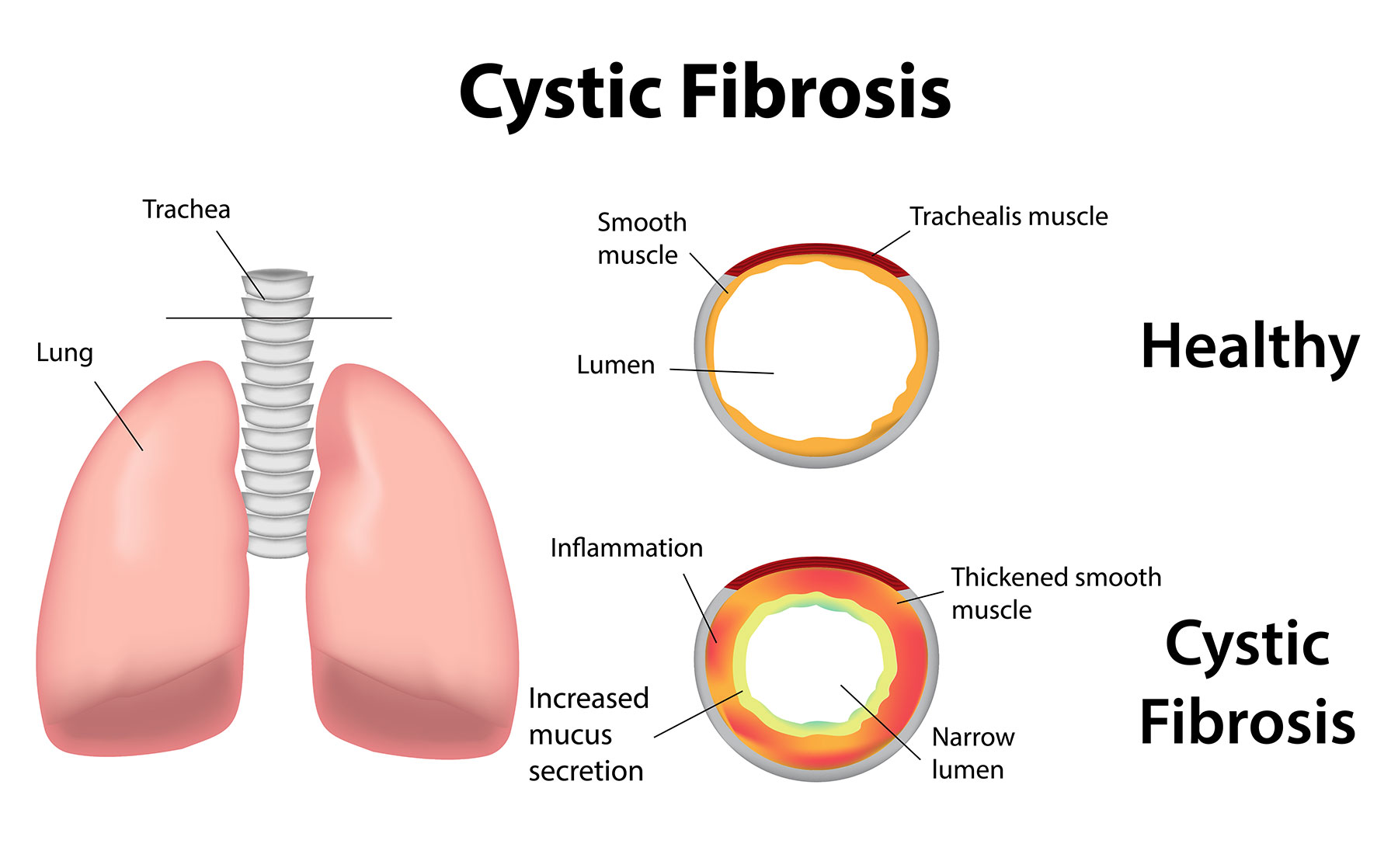 3. Cystic Fibrosis Ribbon Nails - wide 4