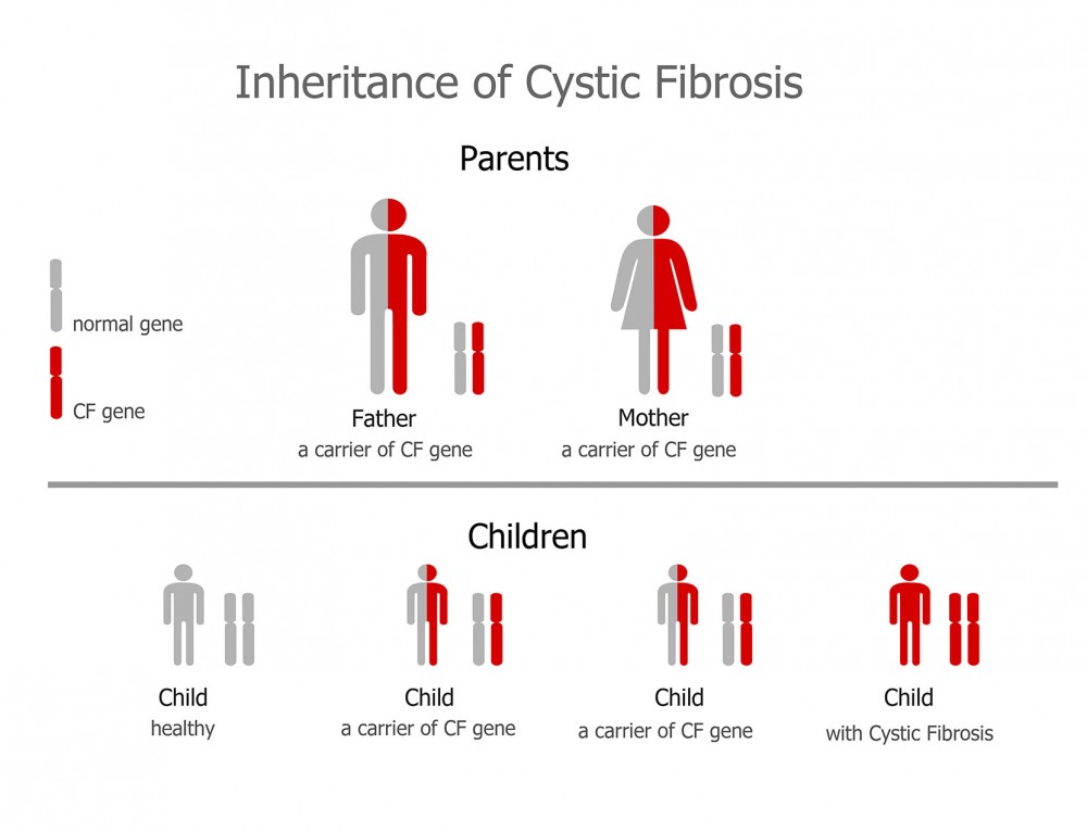 What Causes Cystic Fibrosis Cystic Fibrosis Dna