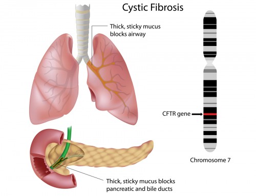 What causes Cystic Fibrosis?
